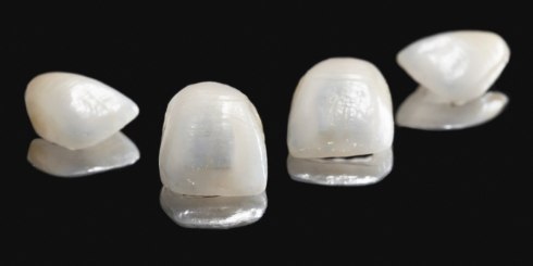 Sample E max dental restorations