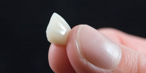 Hand holding an E max dental crown