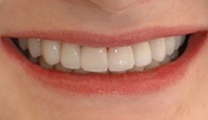 Closeup of Rebecca's smile after smile makeover