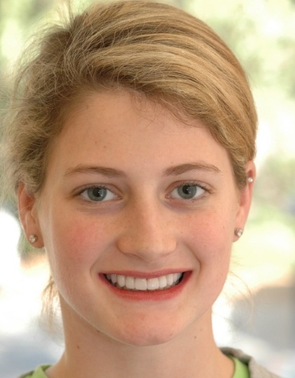 Closeup of Rebecca's smile before smile makeover