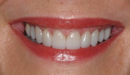 Closeup of Sherr'e smile after smile makeover