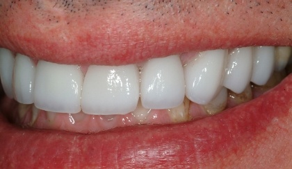 Closeup of Allen's smile after smile makeover