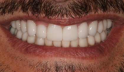 Closeup of Stan's smile after smile makeover