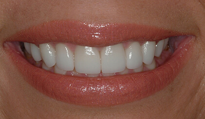 Closeup of Bronwen's smile after smile makeover