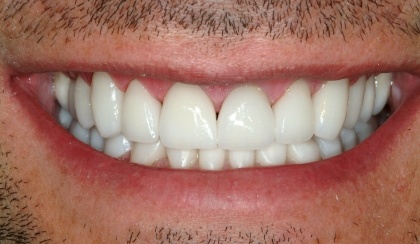 Closeup of Steve's smile after smile makeover