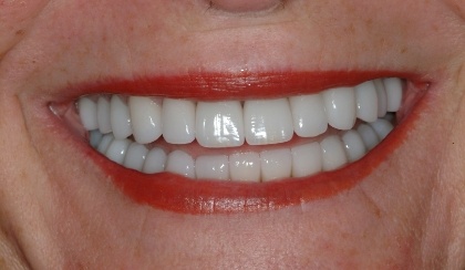 Closeup of Carolyn's smile after smile makeover