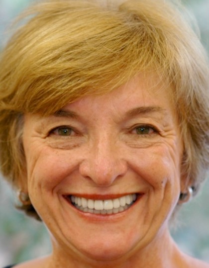 Closeup of Carolyn's smile before smile makeover