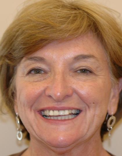 Carolyn smiling before smile makeover