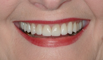Closeup of Gail's smile after smile makeover