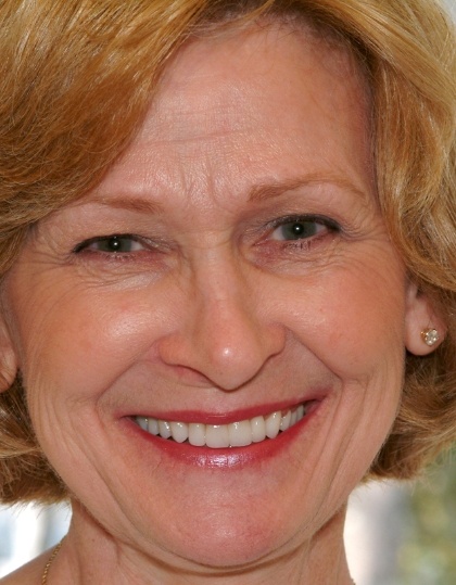 Closeup of Gail's smile before smile makeover