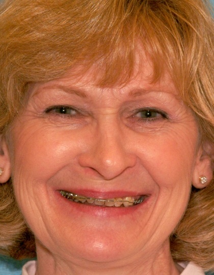 Gail smiling before smile makeover