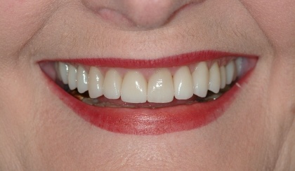Closeup of Jan's smile after smile makeover