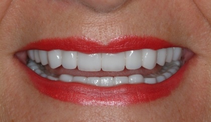 Closeup of Joanne's smile after smile makeover