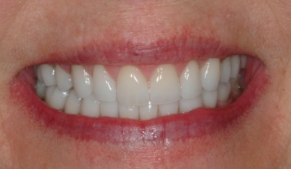 Closeup of Linda's smile after smile makeover