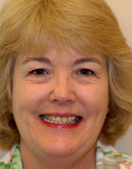 Linda smiling before smile makeover