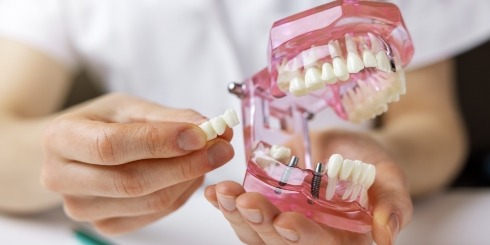 Model smile with dental implant supported dental bridge