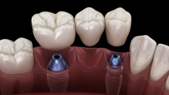 Animated smile during dental implant supported dental bridge placement