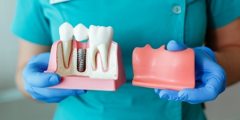 Dentist holding a model comparing natural tooth to dental implant supported dental crown