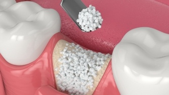 Animated smile during bone grafting