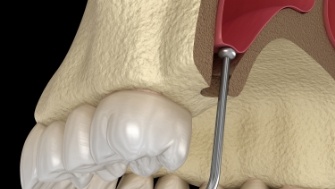 Animated smile during sinus lift procedure