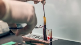 Dentist providing platlet rich plasma and fibrin treatment