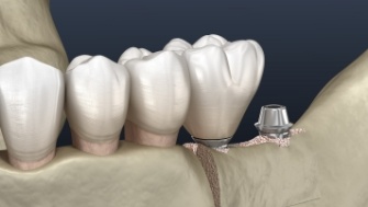 Animated smile showing results of ridge expansion