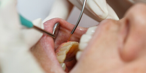 Dentist providing soft tissue laser dentistry