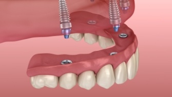 Animated smile during implant denture placement