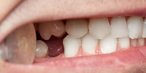 Closeup of gap between teeth