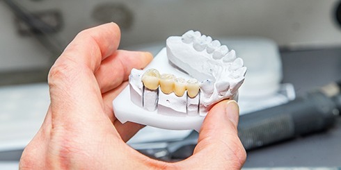 Dental bridge on clay model