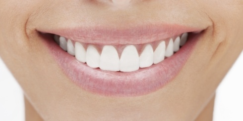 Closeup of woman with flawless smile after full mouth rehabilitation