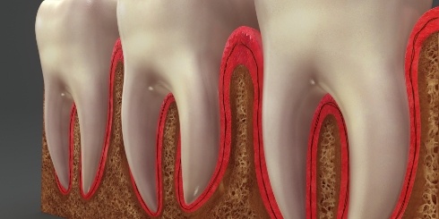 Animated smile with teeth in need of in office gum disease treatment