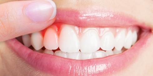 Closeup of smile showing signs of gum disease