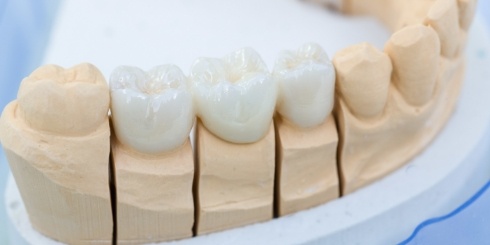 Model smile with dental crown restorations