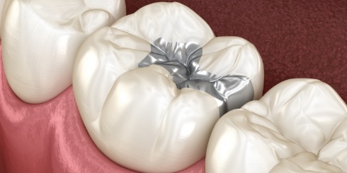 Animated smile with inlay