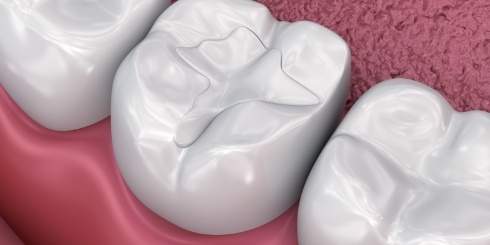 Animated smile with metal free dental restoration