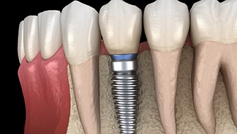 a graphic illustration of an implant-supported crown