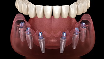 a graphic illustration of six dental implants supporting a full denture