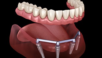 a graphic illustration of All-on-4 dental implants 