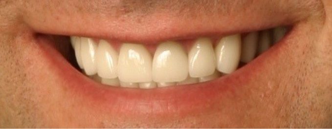 Closeup of Steve's smile after smile makeover