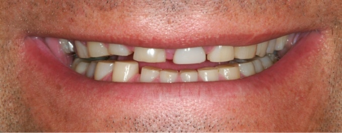 Closeup of Steve's smile before smile makeover