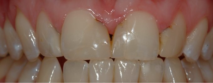 Closeup of Grace's smile before smile makeover