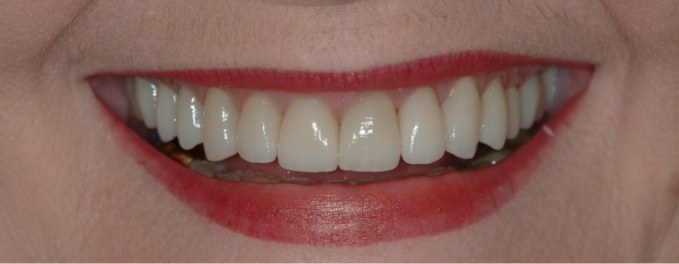 Closeup of Gail's smile after smile makeover