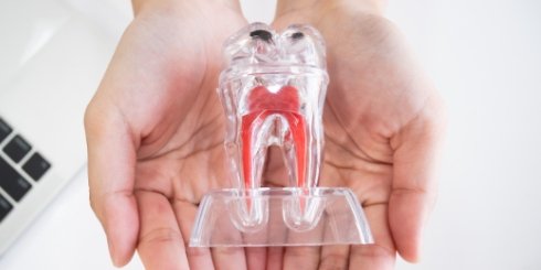 Model of the inside of tooth after root canal treatment