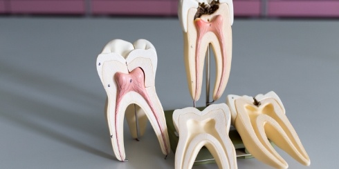 Model of healthy tooth and damaged tooth